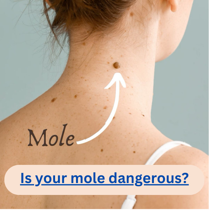 Expose A Secret to Getting Rid of Moles